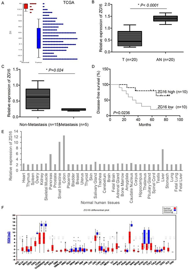 ZG16 is significantly decreased in CRC and correlated with prognosis.