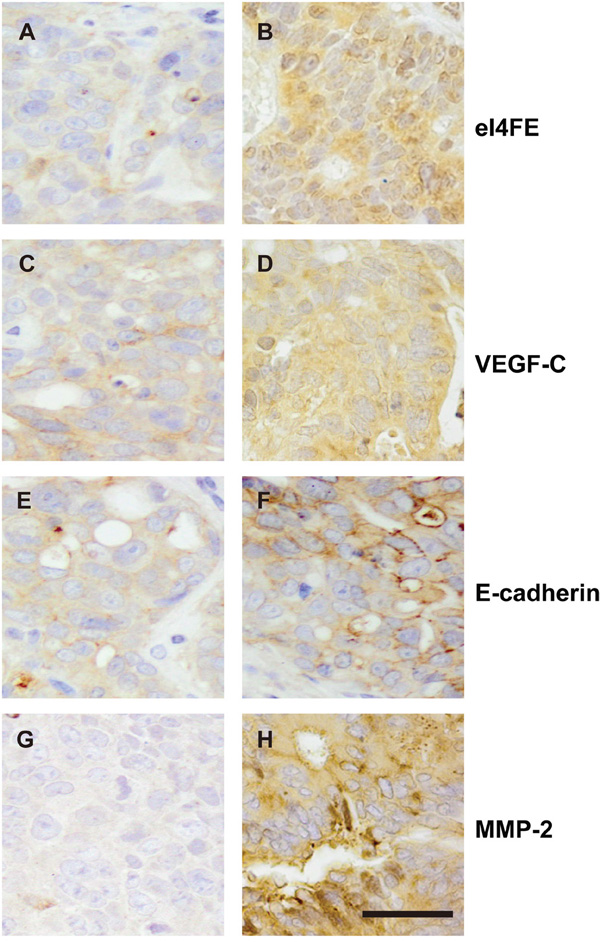 The expression of eIF4E, VEGF-C, MMP-2 and E-cadherin in primary site of patient-derived colon cancer xenografts.