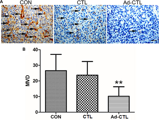 The effect of Ad5/35-TRAIL-CD40L-CTL (Ad-CTL) on pancreatic carcinoma angiogenesis in vivo.