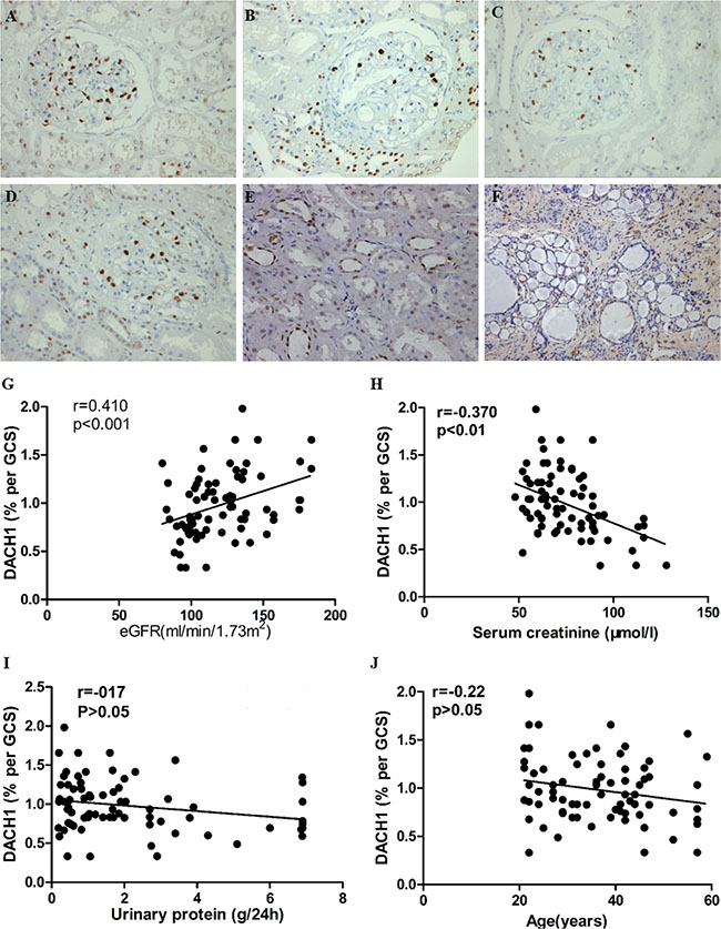 DACH1 expressed in normal and glomerulopathy renal tissue, and correlated with clinical parameters.