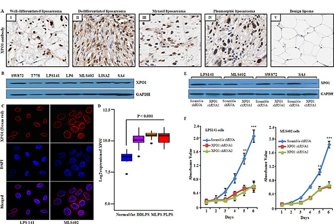 Expression of XPO1 in human liposarcoma tissue and cell lines, and XPO1 knockdown in liposarcoma cells.