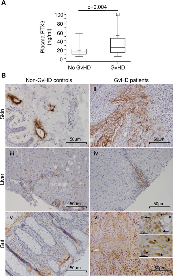 PTX3 levels in the plasma of HSCT patients at disease onset and PTX3 protein production in biopsies from GvHD target organs.