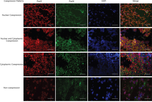 Immunofluorescence staining results of the localization and co-expression of molecular chaperone Piwil2/Piwil4 in HCC tissues.