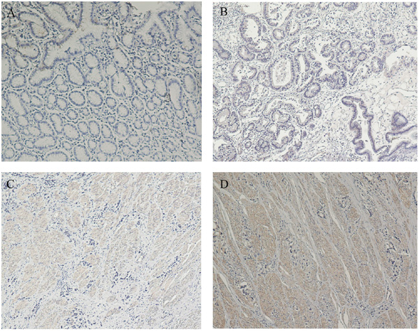 ANXA3 protein expression in gastric cancer surgical specimens shown by immunohistochemistry.