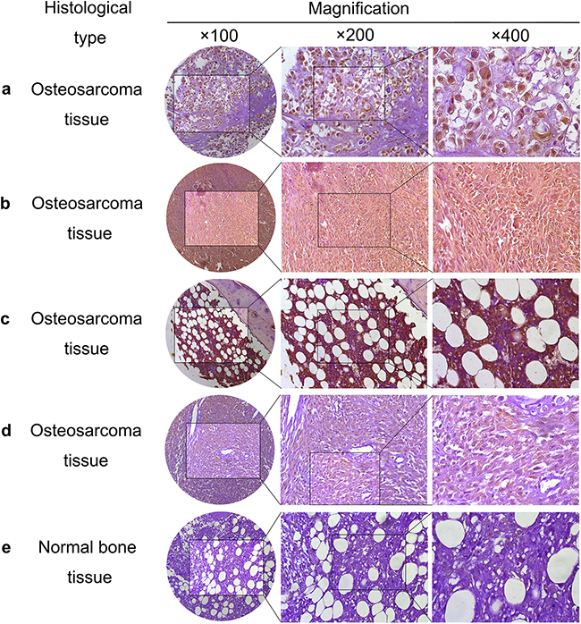 PSMC2 expression in osteosarcoma samples.