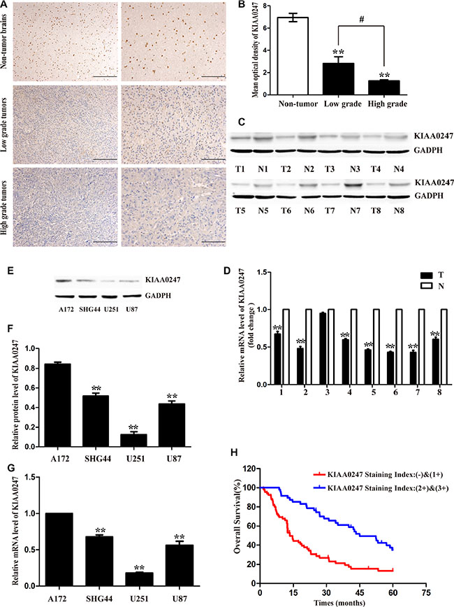 Low KIAA0247 expression predicted a worse prognosis for patients with glioma.