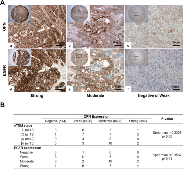 IHC for OPN and EGFR in human HCC tissue samples.