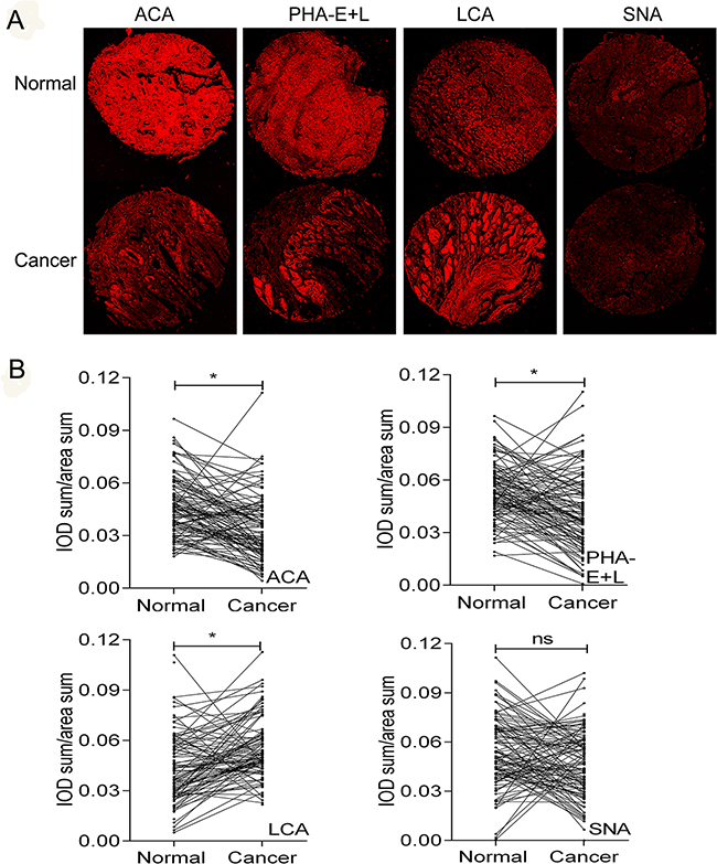 Differential glycopatterns in gastric cancer and normal gastric epithelial tissues evaluated by lectin histochemistry.