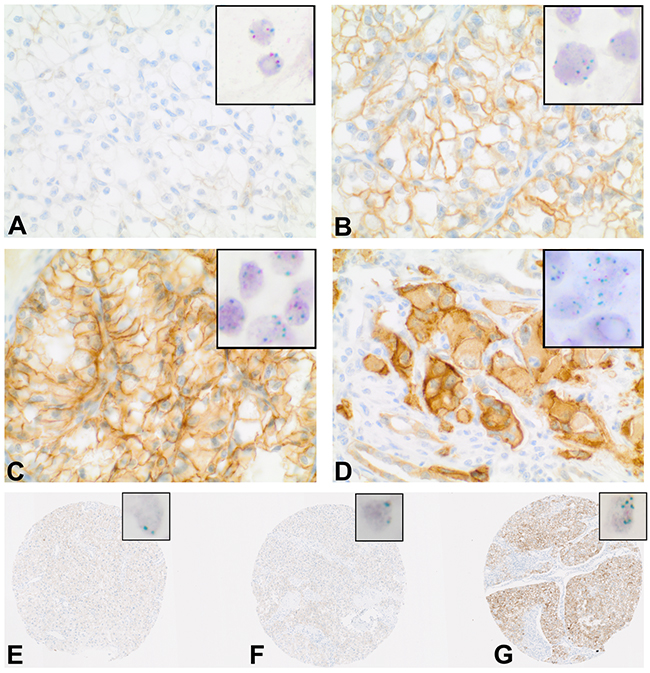 HGFR expression and MET copy number in clear-cell RCC.