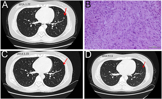 The image and pathological data of the left lung metastase in the CR patient.