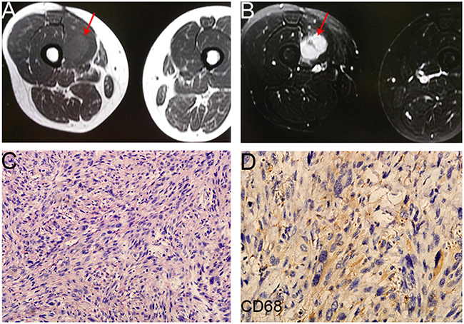 The image and pathological data of the primary lesion (the right thigh) in one PR patient.