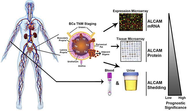 Summary of the multi-level approach for analysis of ALCAM in bladder cancer.