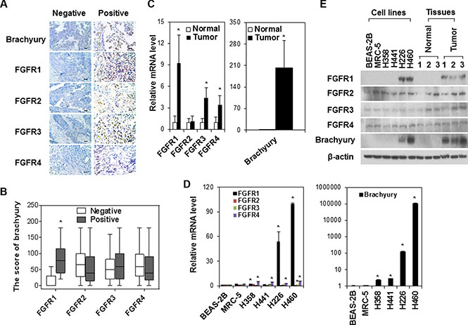 The association of FGFR and brachyury expressions in human lung tumor tissues and cell lines.