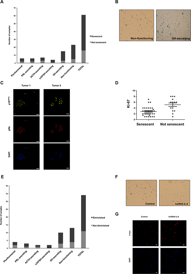 Human pituitary tumor samples express SA-b-gal modulated by IL-6.