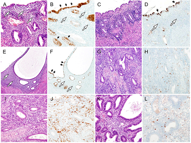 Stromal p16 expression in benign endometrial lesions.