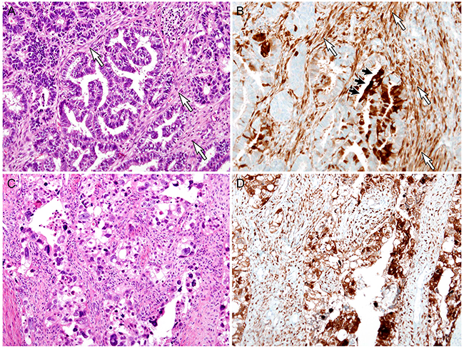 Stromal p16 overexpression in malignant endometrial lesions: Endometrioid carcinoma (EC) and serous carcinoma (SC).