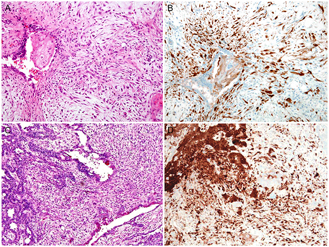 Stromal p16 overexpression in malignant endometrial lesions: Carcinosarcoma.