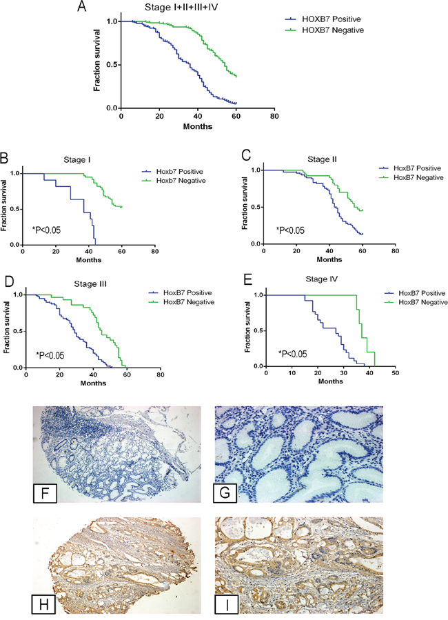 HOXB7 expression in gastric cancer patient tissues correlates with decreased overall survival and more aggressive tumor characteristics.