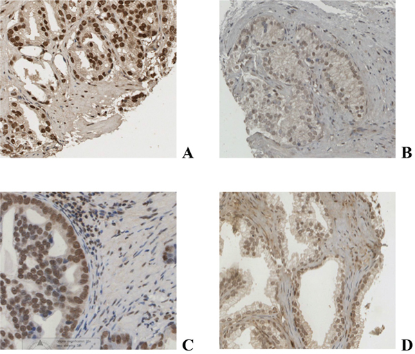 Immunohistochemical staining of prostate cancer tissue for AR A., pAR