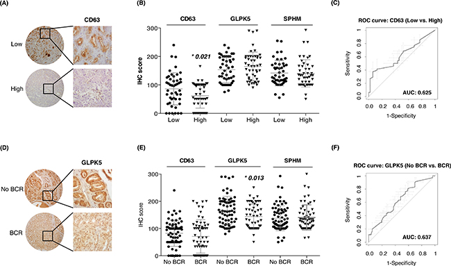 Assessment of aggressive PCa biomarkers in tissue microarrays.