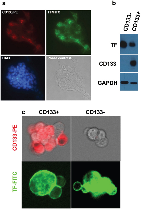 TF expression on CD133+ CSCs isolated from OVCAR-5 line, MDA-MB-231 line and from patients&#x2019; breast tumor tissues.