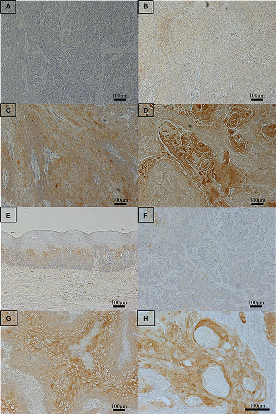 NHE1 protein expression in human esophageal squamous cell carcinoma (ESCC).