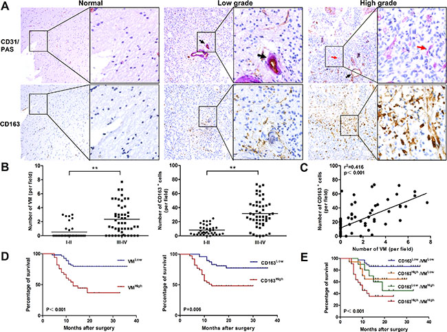 Correlation of VM level with CD163 expression in human glioma tissue and overall survival for glioma patients.
