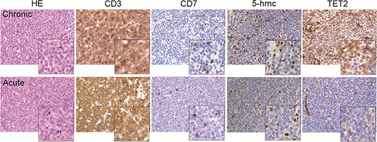 Assessment of 5-hmc level and TET2 expression in ATLL tumor T cells.