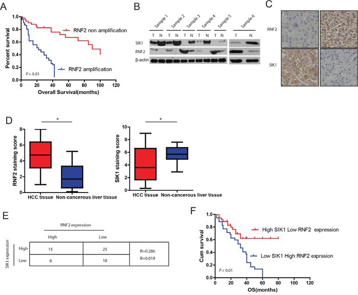 Expression patterns of RNF2 and SIK1 in human HCC.