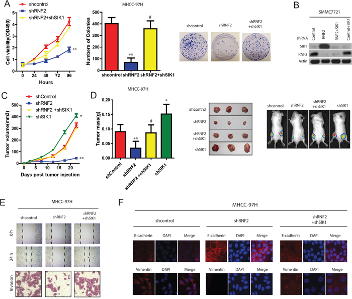 RNF2 promotes HCC cell proliferation and invasion partially through SIK1 ubiquitination.