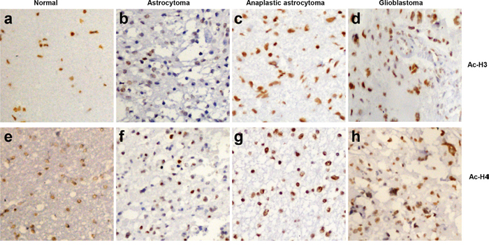 The expression of acetyl-histones 3 and 4 in gliomas.