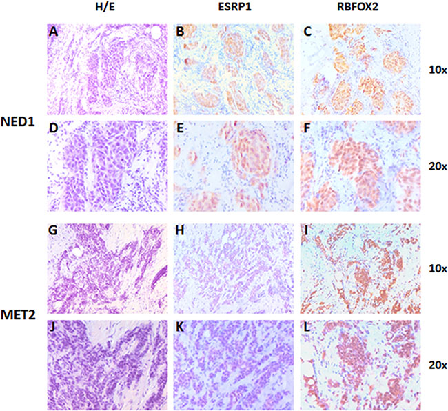 Representative images of ESRP1 and RBFOX2 expression in early breast cancer tissue of NED 1 (T2N0M0 at time of diagnosis) and MET 2 samples (T2N0M0 at time of diagnosis).