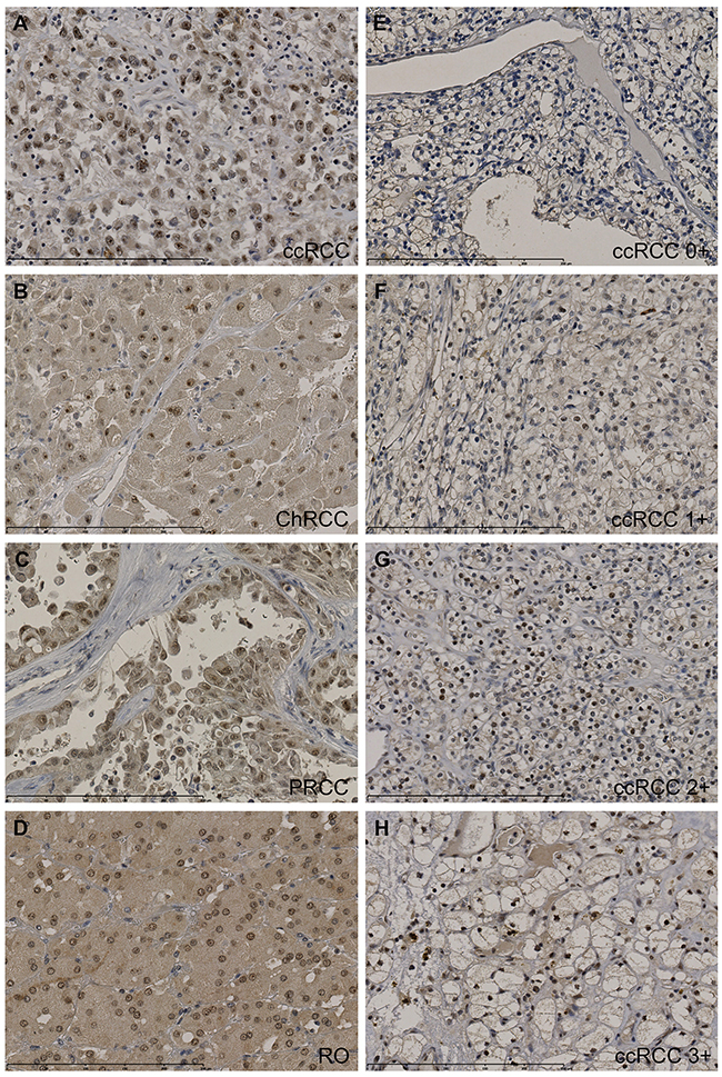 Tissue micro arrays including ccRCC (n=105), PRCC (n=27), ChRCC (n=8), UcRCC (n=2), RO (n=13) and normal renal cortex (n=146) were immunohistochemically stained for CK2&#x03B1;.