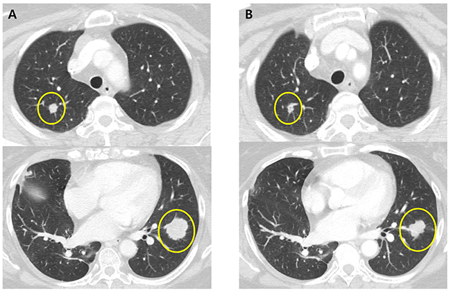 CT scans of the chest in patient with metastatic colorectal cancer harboring FLT3 amplification.