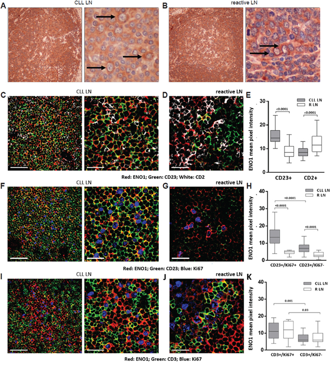 In lymph node ENO1 is significantly more expressed by proliferating CLL cells.