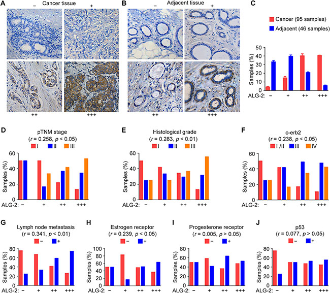 Upregulation of ALG-2 in breast cancer tissues is associated with clinicopathological parameters related to tumor malignancy.
