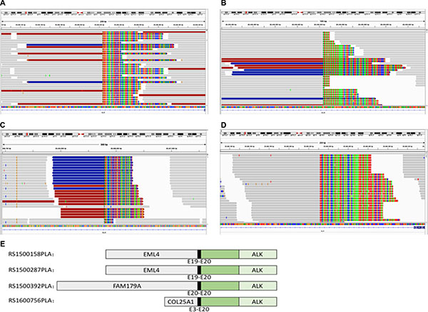 Integrative Genomics Viewer (IGV) screenshot showing that the breakpoints on the ALK gene detected by capture-based next-generation sequencing were identical among different blood samples.