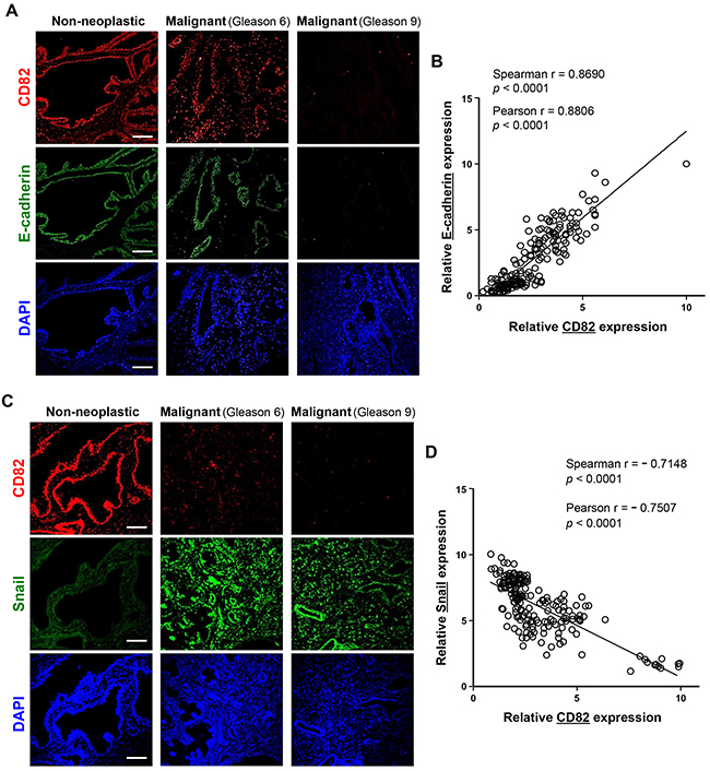 Expression levels of CD82, E-cadherin, and Snail in human prostate cancer tissue samples.