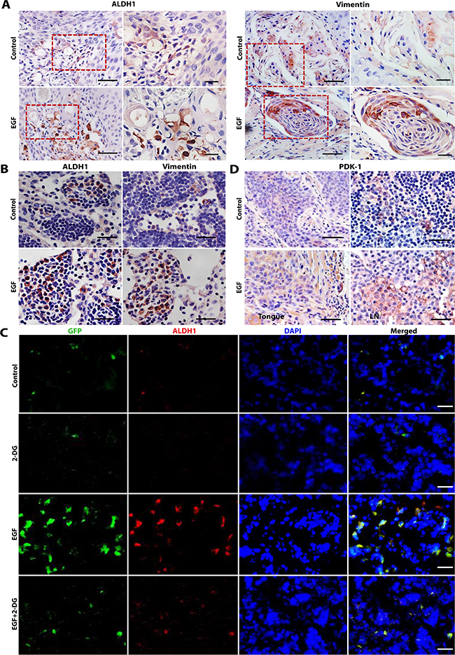 2-DG treatment suppresses EGF-facilitated regional cervical lymph node metastasis in an orthotopic tongue model of OSCCs in nude mice.