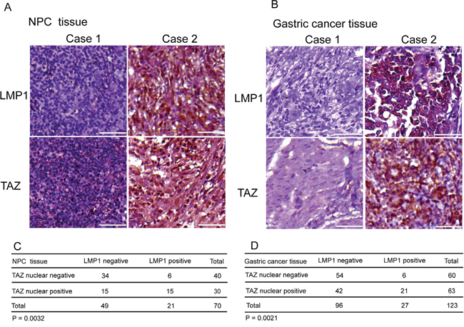 Association of TAZ upregulation with LMP1 in human NPC and gastric cancer samples.