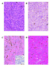 Expression of LHRH receptor protein in enucleated human uveal melanoma tissue samples demonstrated by immunoperoxidase staining.