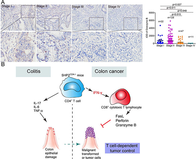 Anti-tumor immunity negatively correlates with the malignance of human colon cancer.