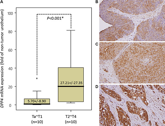 Validation of DPP4 mRNA level and DPP4 protein expression in urinary carcinoma (UC) specimens.
