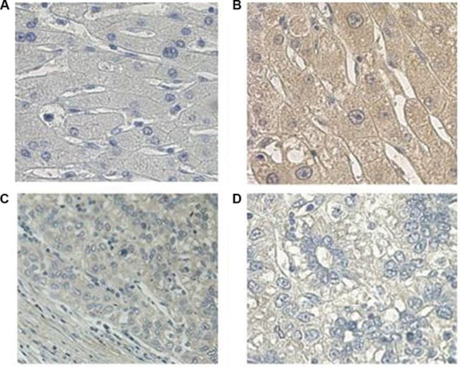 Immunohistochemical analysis of PCDH20 expression in hepatocellular carcinoma.
