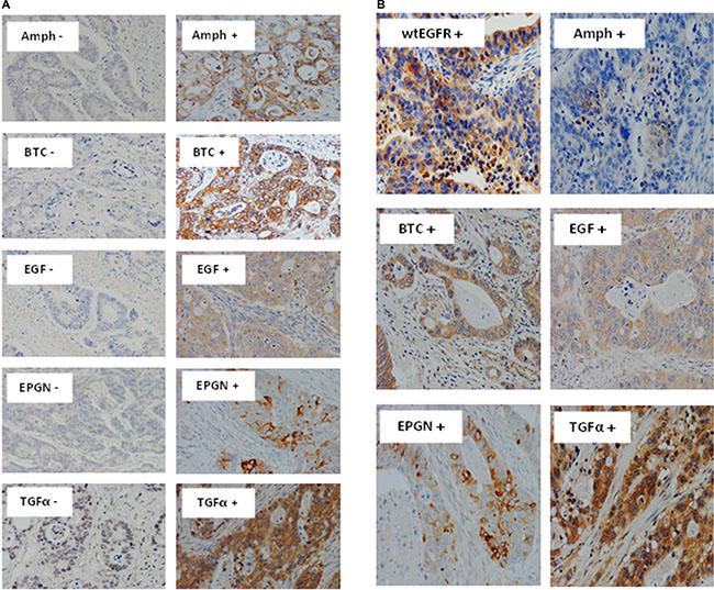 Immunostaining of EGFR ligands and co-expression with wtEGFR in mCRC specimens.
