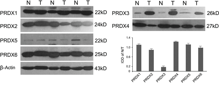 Representative expression profiles of PRDXs in LSCC tissues (n=48).