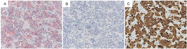 In situ hybridization to characterize ALK RNA and sweyjawbu RNA expression in lymphoma cells.
