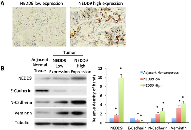 High expression of NEDD9 related to epithelial-mesenchymal transition.