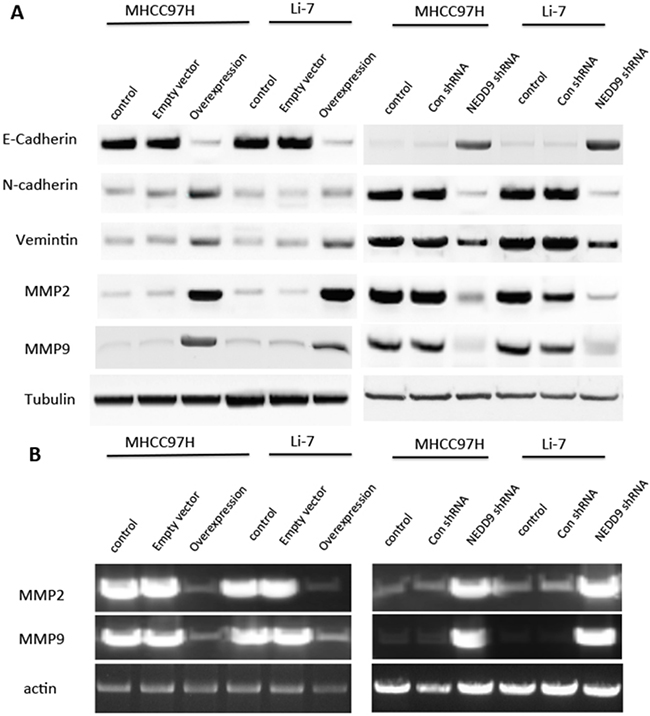 NEDD9 regulated epithelial-mesenchymal transition markers and matrix metalloproteinases in hepatocellular carcinoma cells.