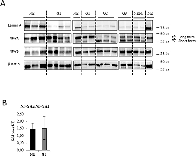 Analysis of NF-YA isoforms and lamin A protein expression in benign and EC tissues.